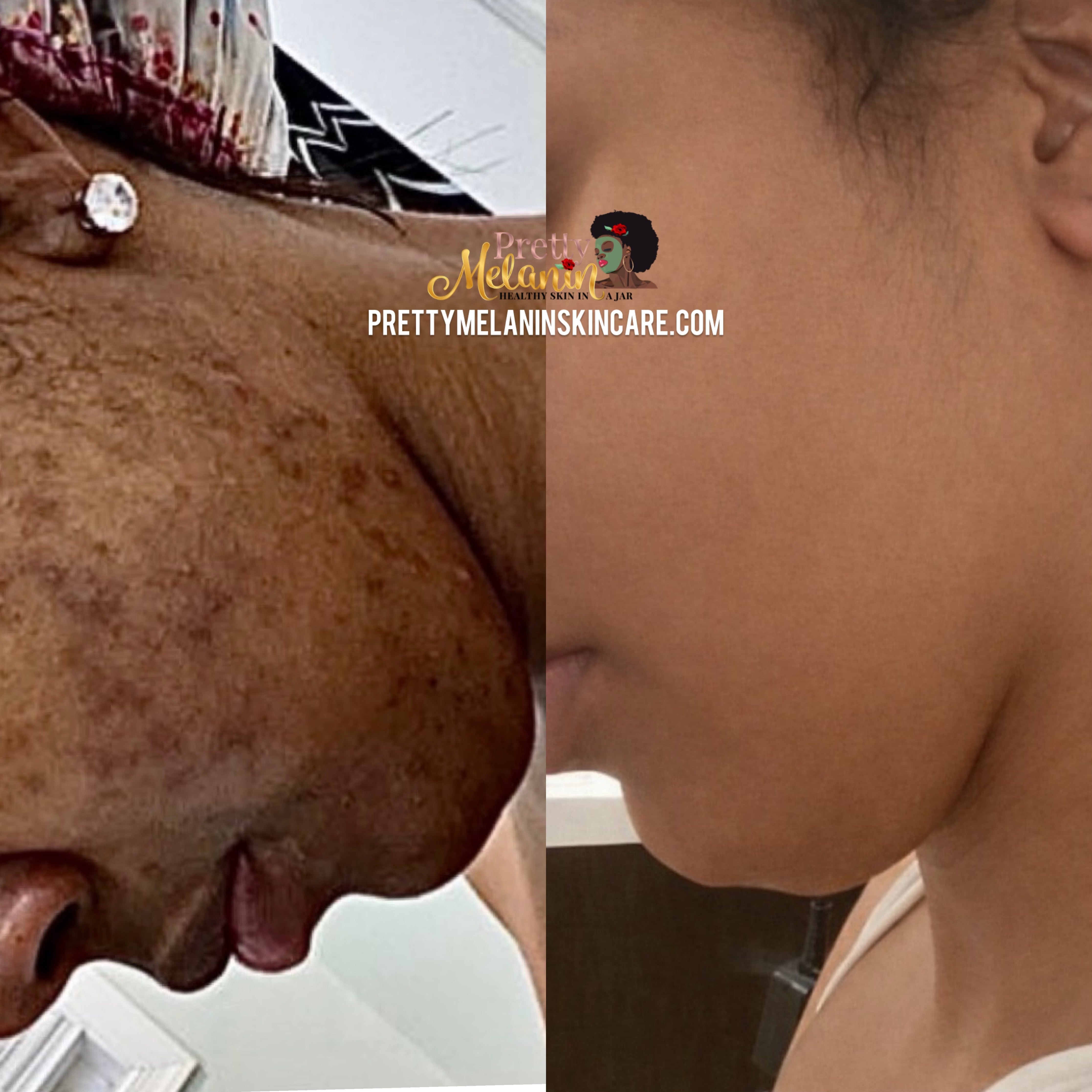 Even Tone Repair Cleanser (Hyperpigmentation, Dark Spots, Acne scars)