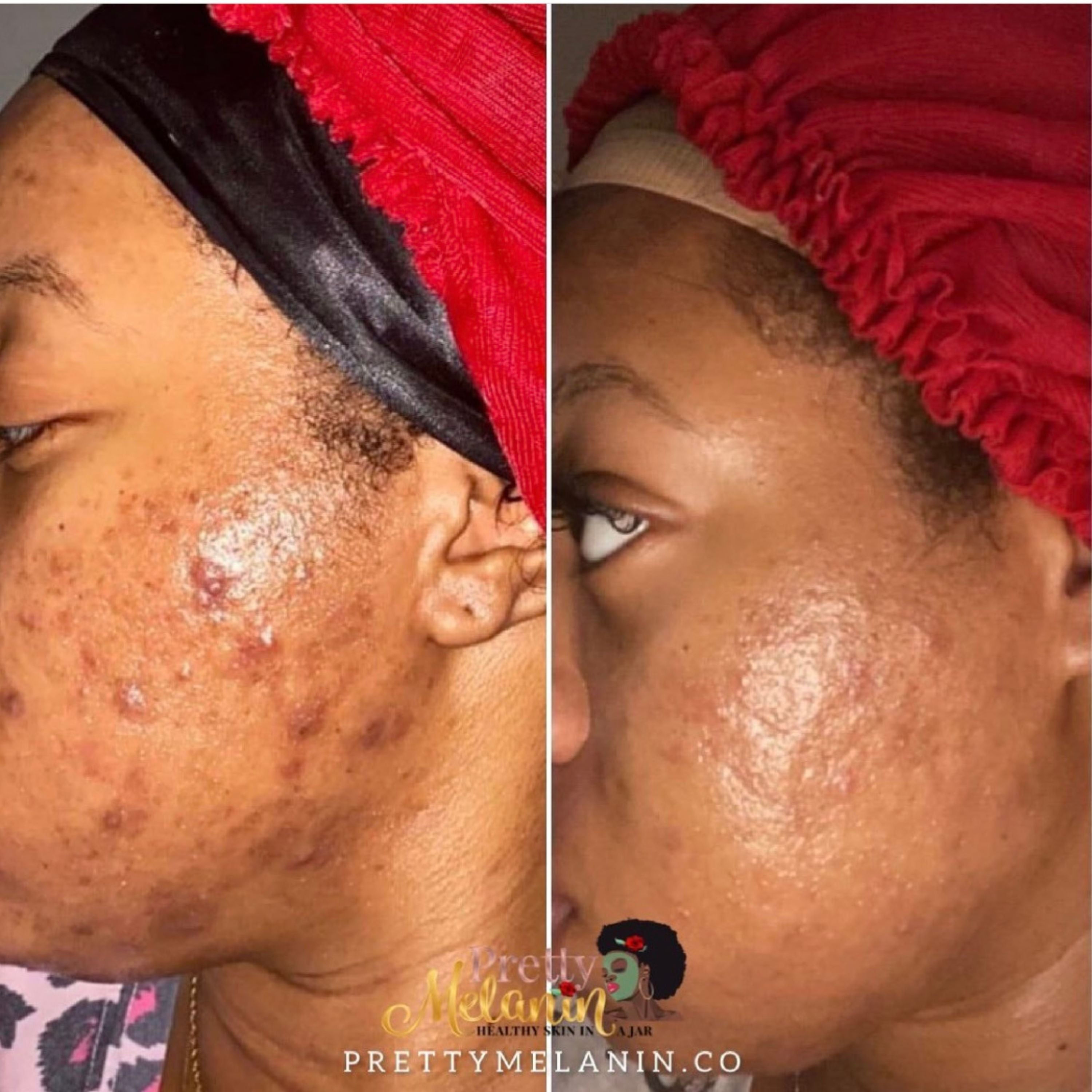 exfoliation before and after